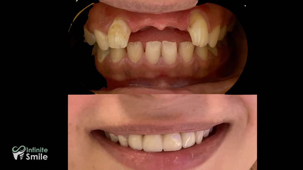 Caz înainte și după, Infinite Smile Sibiu, 3
